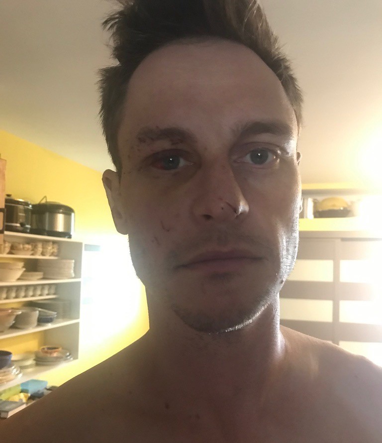 After crashing his car into a parked construction vehicle in the early hours of July 12, 2024, Iain McCormick suffered a concussion, a broken orbital bone, a torn right rotator cuff, and a torn ligament in his left knee.